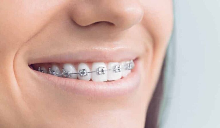 Braces Can Be Expensive Which is Why You Need This Cashback MasterCard