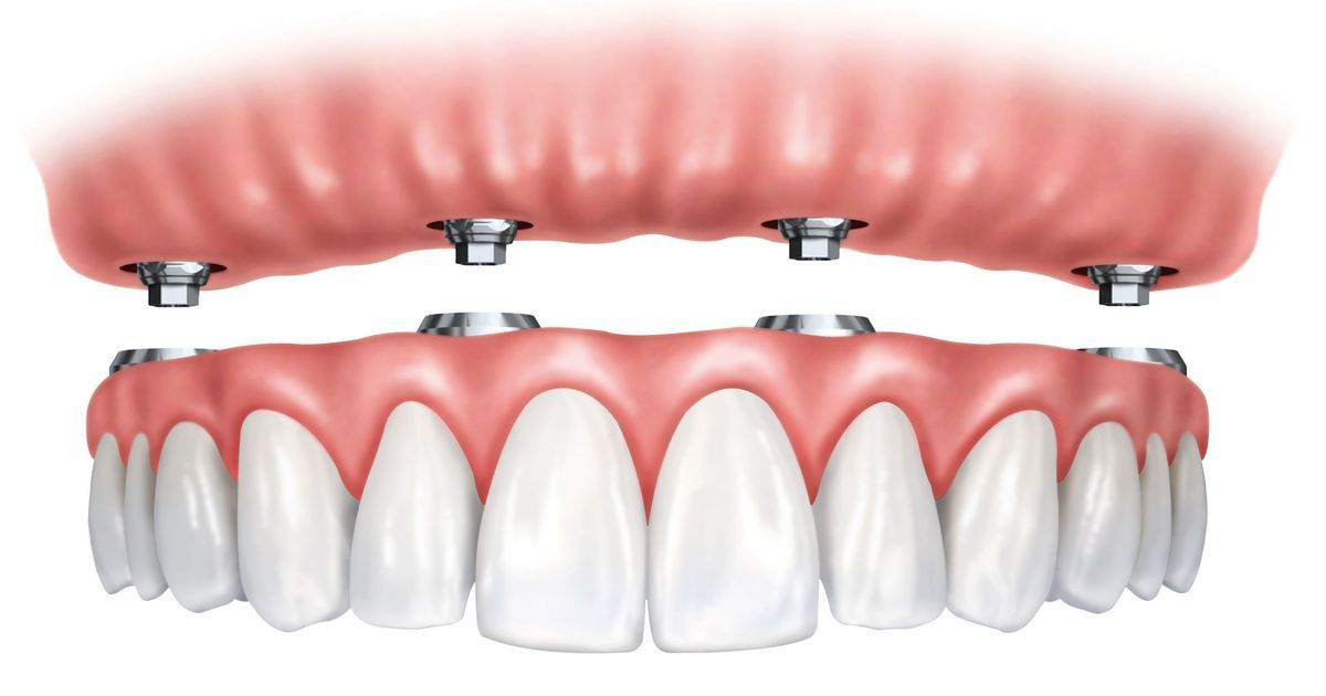 Snap-on veneers vs. fixed dentures: Which is best and why?